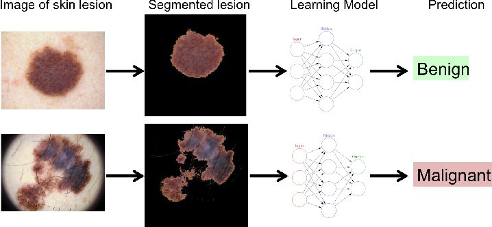 Diagram illustrating the process of a computer vision system classifying skin legions as benign or malignant. 