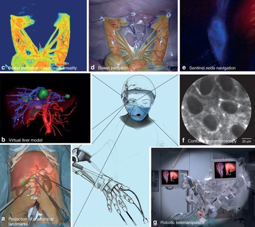 Computer vision applied to robotics used in surgical applications