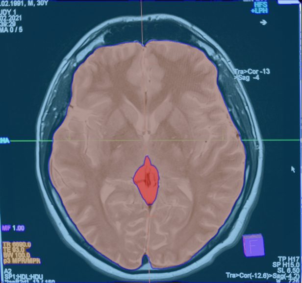 Medical scan segmentation