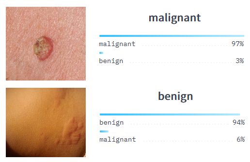 skin-cancer-classification-machine-learning-model-ai-vision