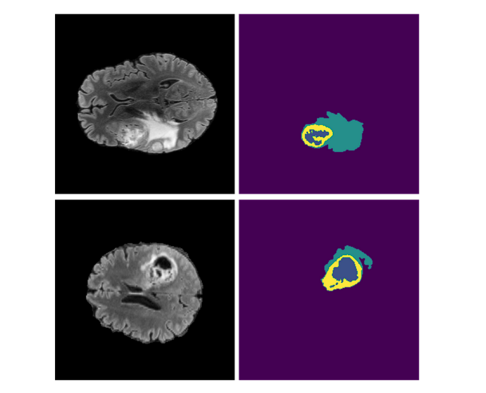 image segementation of human brain